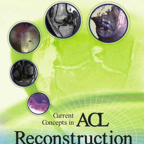 Current Concepts in ACL Reconstruction