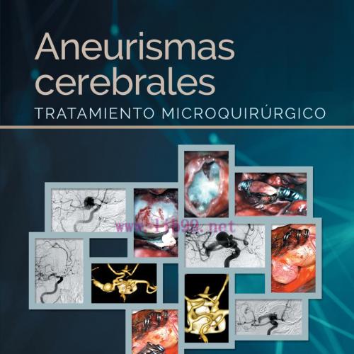 [AME]Aneurismas cerebrales: Tratamiento microquirúrgico (Original PDF)