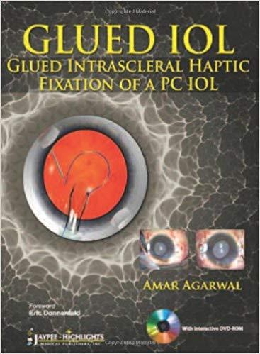 GLUED IOL Glued Intrascleral Haptic Fixation of a PC IOL [Agarwal Amar]