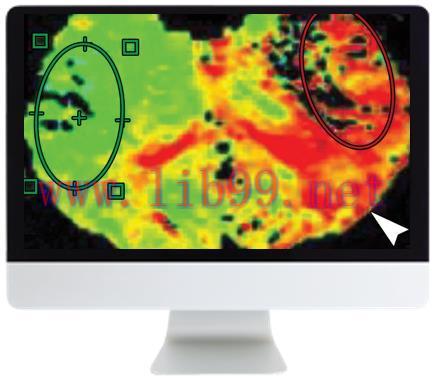 [AME]Code Stroke: What the Radiologist Needs to Know in the Changing Landscape of Acute Ischemi...