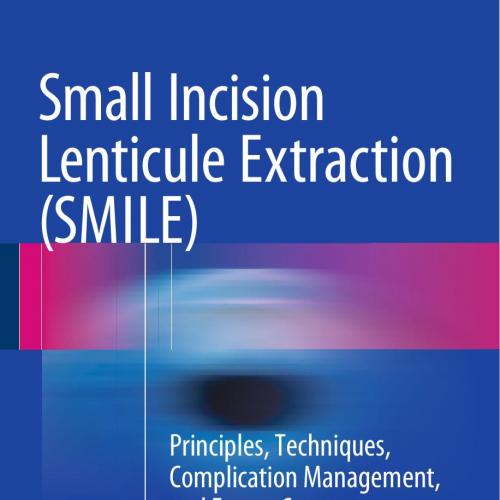 Small Incision Lenticule Extraction (SMILE) Principles, Techniques, Complication Management, an...