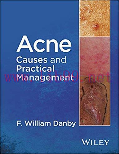(PDF)Acne: Causes and Practical Management 1st Edition