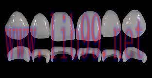[AME]Gidedental Prosthetic Rehabilitation on Natural Teeth – Predictable, Esthetic and Systemat...
