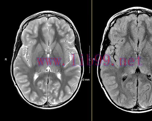 [AME]MRIOnline Imaging Mastery Series: Neurocutaneous Syndromes 2021 (CME VIDEOS)
