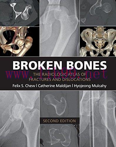 [AME]Broken Bones: The Radiologic Atlas of Fractures and Dislocations (EPUB)