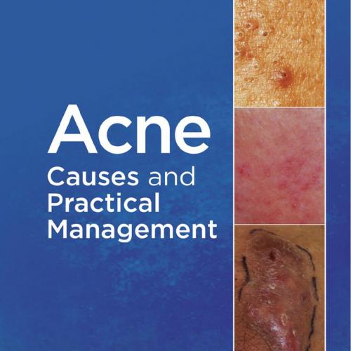 Acne Causes and Practical Management - F. William Danby
