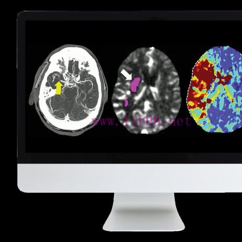 [AME]ARRS Code Stroke: What Every Radiologist Should Know 2022 (CME VIDEOS)