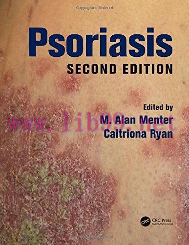 [AME]Psoriasis, Second Edition (PDF)