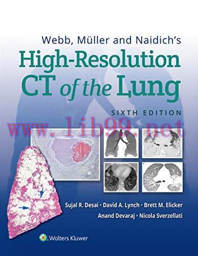 [AME]Webb, Müller and Naidich’s High-Resolution CT of the Lung, 6ed (azw3+Converted PDF)