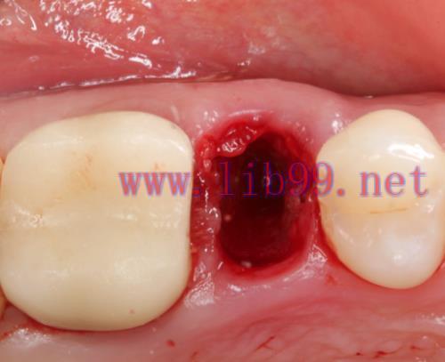 [AME]Gidedental Extraction Socket – Preservation/Grafting; Immediate vs Delayed Implants; Ponti...