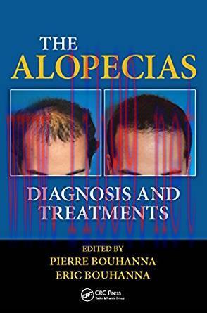 [PDF]The Alopecias Diagnosis and Treatments