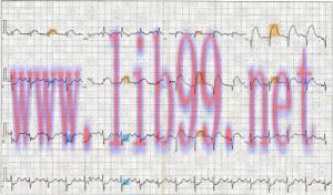 [AME]Physician Assistant Care Series – 12 Lead EKG Review (EPUB)