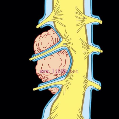[AME]MRIOnline MRI Mastery Series: Extradural Lesions 2020 (CME VIDEOS)