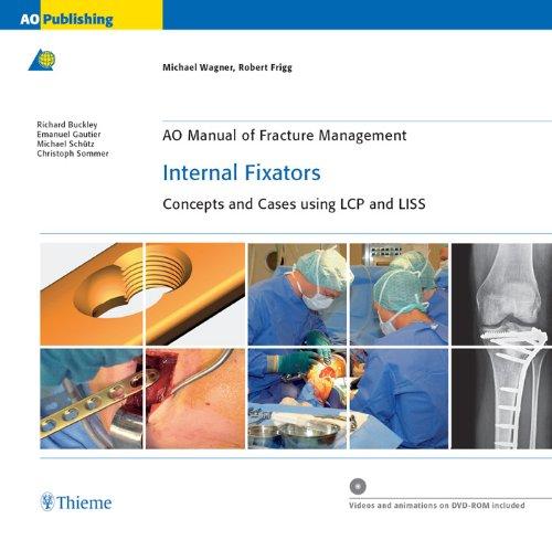 AO Manual of Fracture Management - Internal Fixators (包含视频)