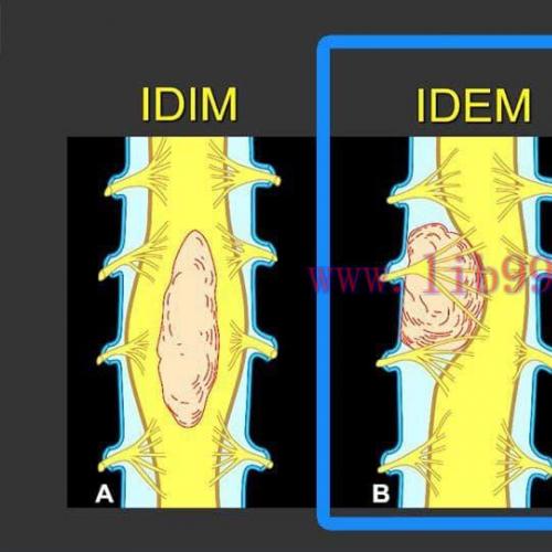 [AME]MRIOnline MRI Mastery Series: Intradural Extramedullary Lesions (IDEM) 2020 (CME VIDEOS)