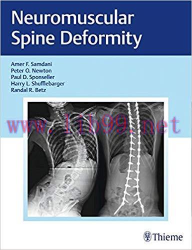 [PDF]Neuromuscular Spine Deformity