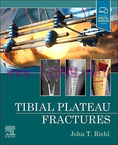 [AME]Tibial Plateau Fractures (EPUB + Converted PDF)