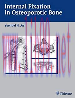 [PDF]Internal Fixation in Osteoporotic Bone