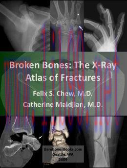 [AME]Broken Bones: The X-Ray Atlas of Fractures (EPUB)