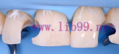 [AME]Gidedental Direct and Indirect Adhesive Restorations – Minimal Invasive Treatment of the A...