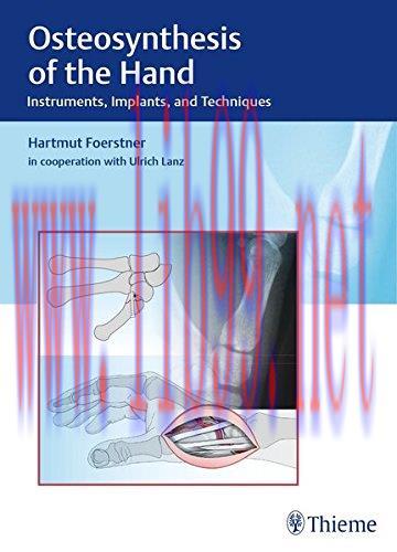 [AME]Osteosynthesis of the Hand: Instruments, Implants, and Techniques (EPUB)