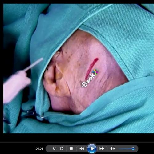 Flaps and Grafts in Dermatologic Surgery 2nd Edition Videos