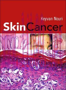 [AME]Skin Cancer